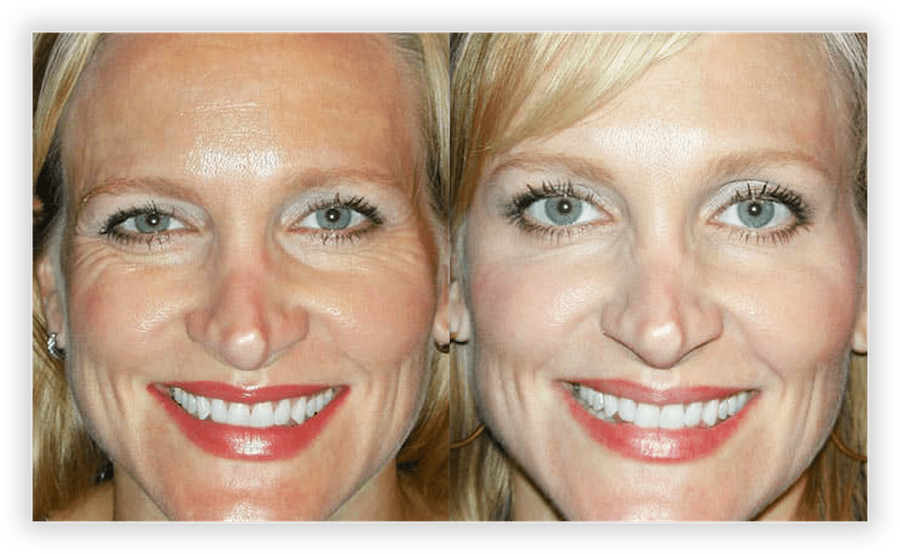 Non Surgical Facelift 2